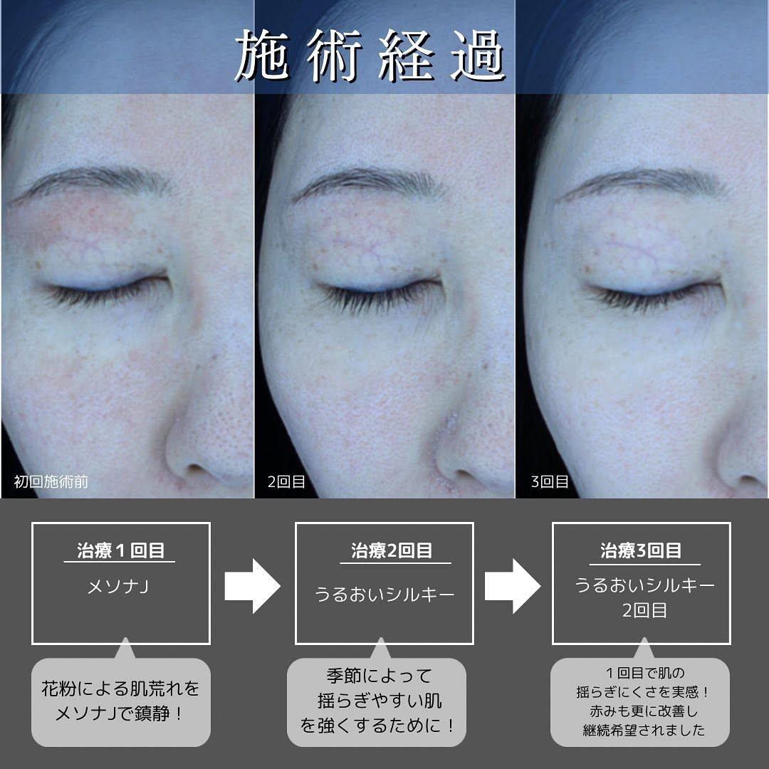 ゆらぎ肌の原因と治療｜赤みの種類（乾燥・炎症・真皮の衰え・血管拡張）で選ぶアプローチ 画像2