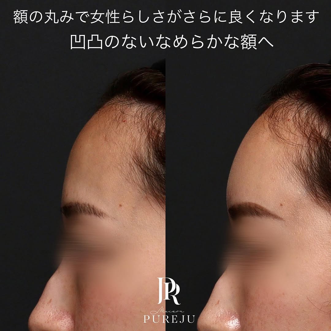 額・こめかみへのヒアルロン酸注射で顔に丸みと女性らしい柔らかい印象を出した症例 画像3