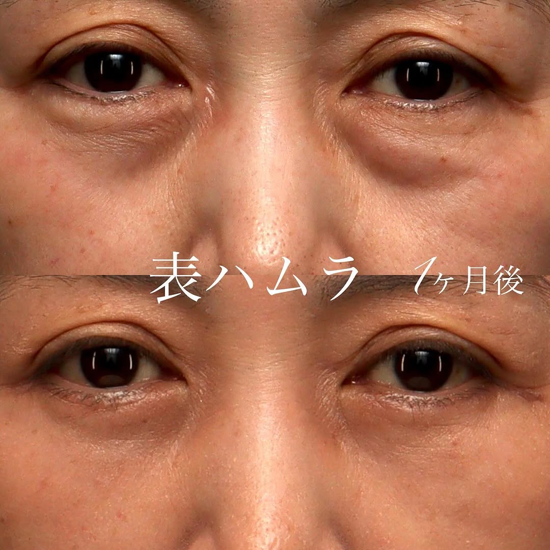 表ハムラでたるみ・膨らみ・へこみをまとめて改善した目の下クマの症例