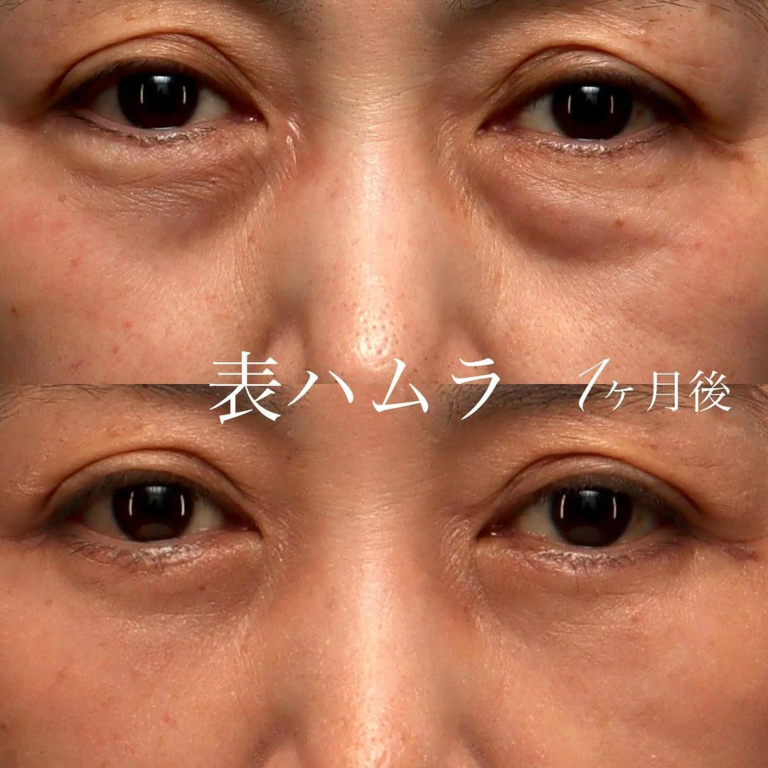 表ハムラでたるみ・膨らみ・へこみをまとめて改善した目の下クマの症例