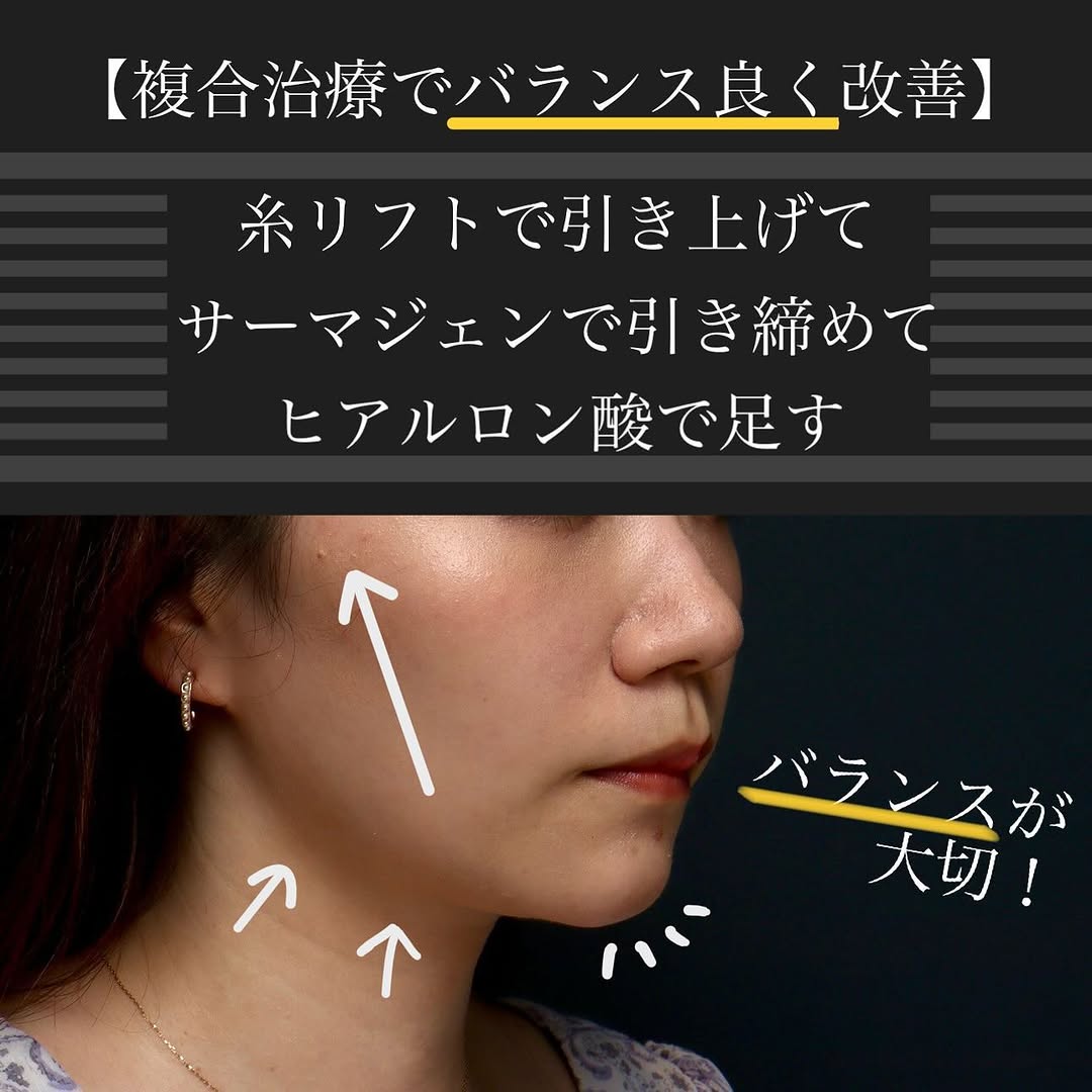 糸リフト＋サーマジェン＋ヒアルロン酸＋ボトックスのコンビネーションでバランス良く小顔に整えた症例 画像4