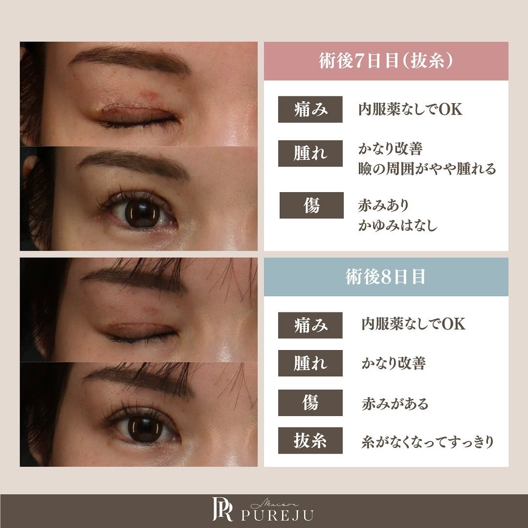 二重全切開（修正）のダウンタイムはどのくらい？術直後〜1ヶ月の経過と過ごし方を解説 画像5
