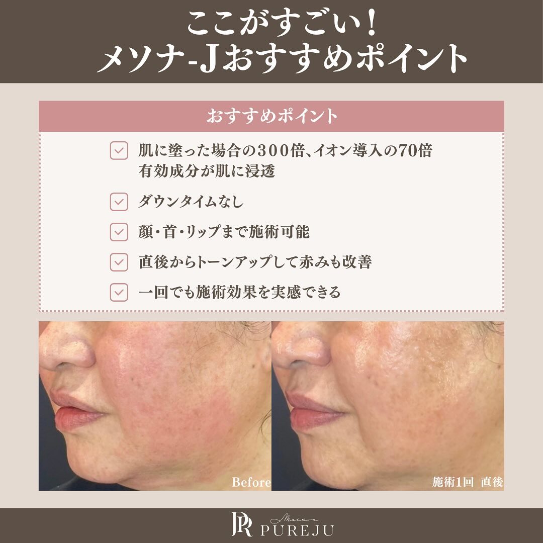 メソナJのピンク・プレミアム2コース比較｜導入薬剤と当院5つのこだわりを徹底解説