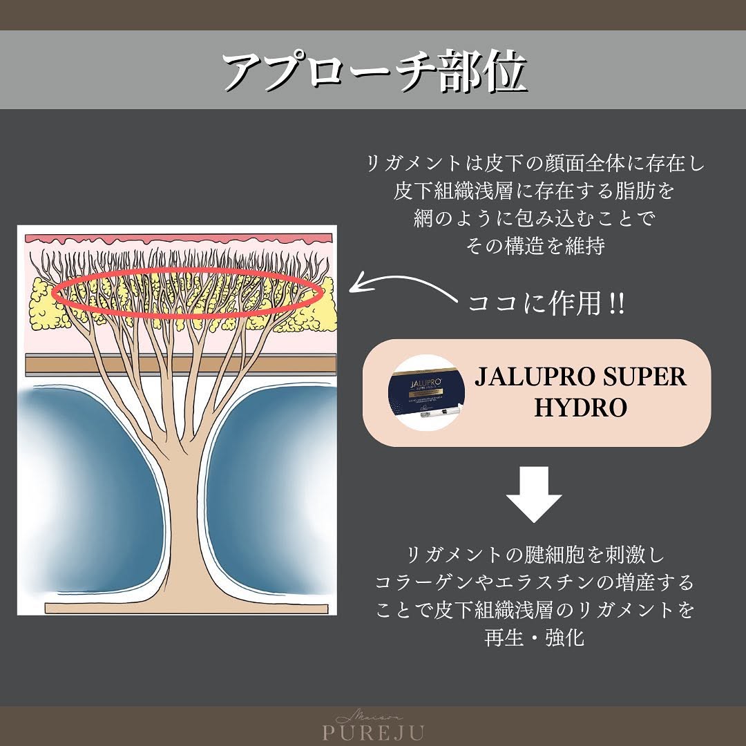 ジャルプロスーパーハイドロとは｜リガメントを強化してたるみ・ハリを根本から改善する注入治療 画像5