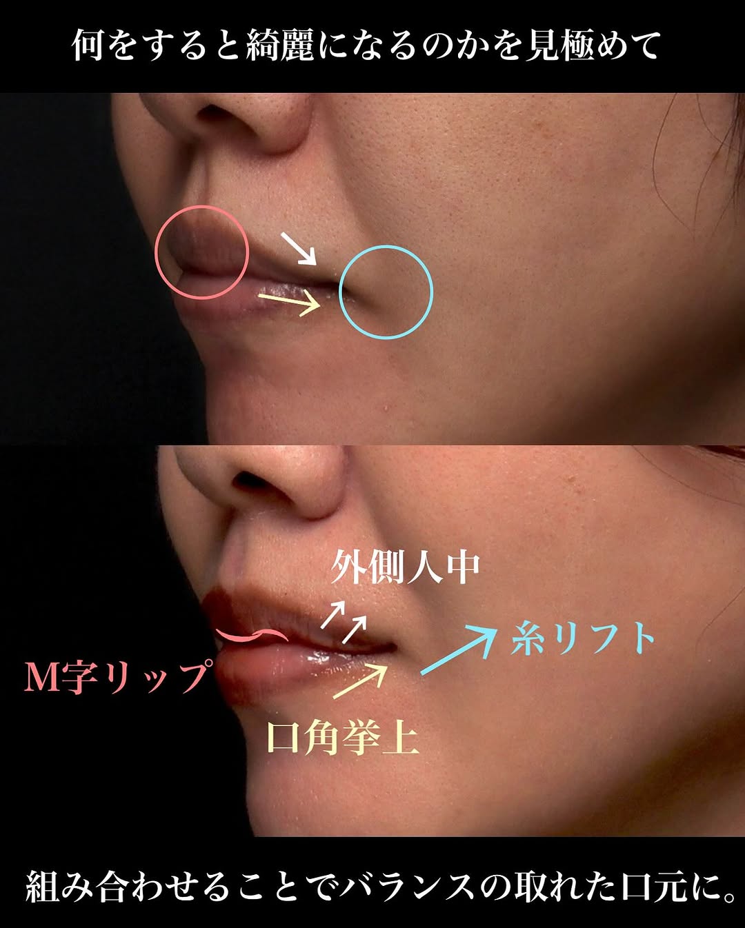 口角挙上＋外側人中＋人中短縮の複合治療で唇と口元全体のバランスを整えた症例 画像2
