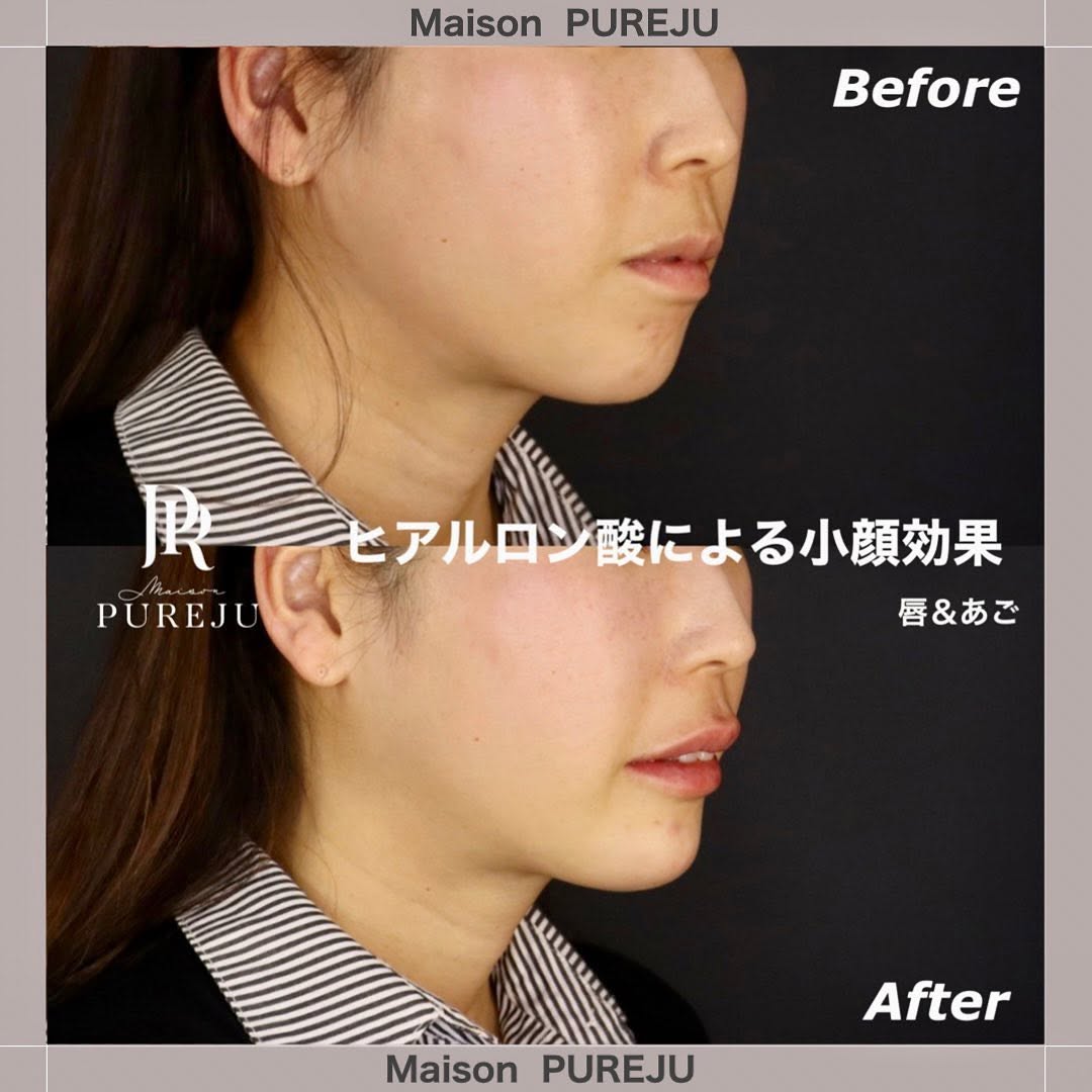 ヒアルロン酸注入で整える横顔｜あご+唇で小顔効果とEライン改善 画像3