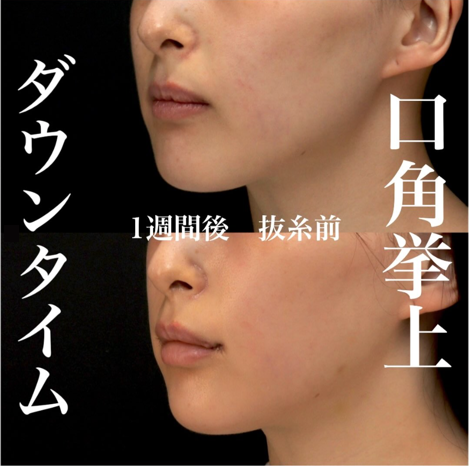 口角挙上のダウンタイム経過、抜糸前でも縫合糸が目立ちにくい症例（術後1週間） 画像2