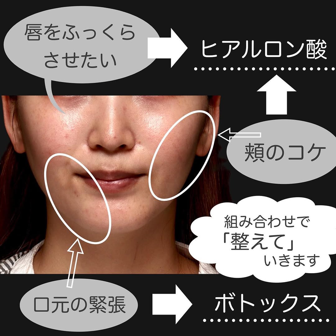 ボトックス×ヒアルロン酸（頬・唇）のトータル注入で上品な印象に整えた症例 画像2