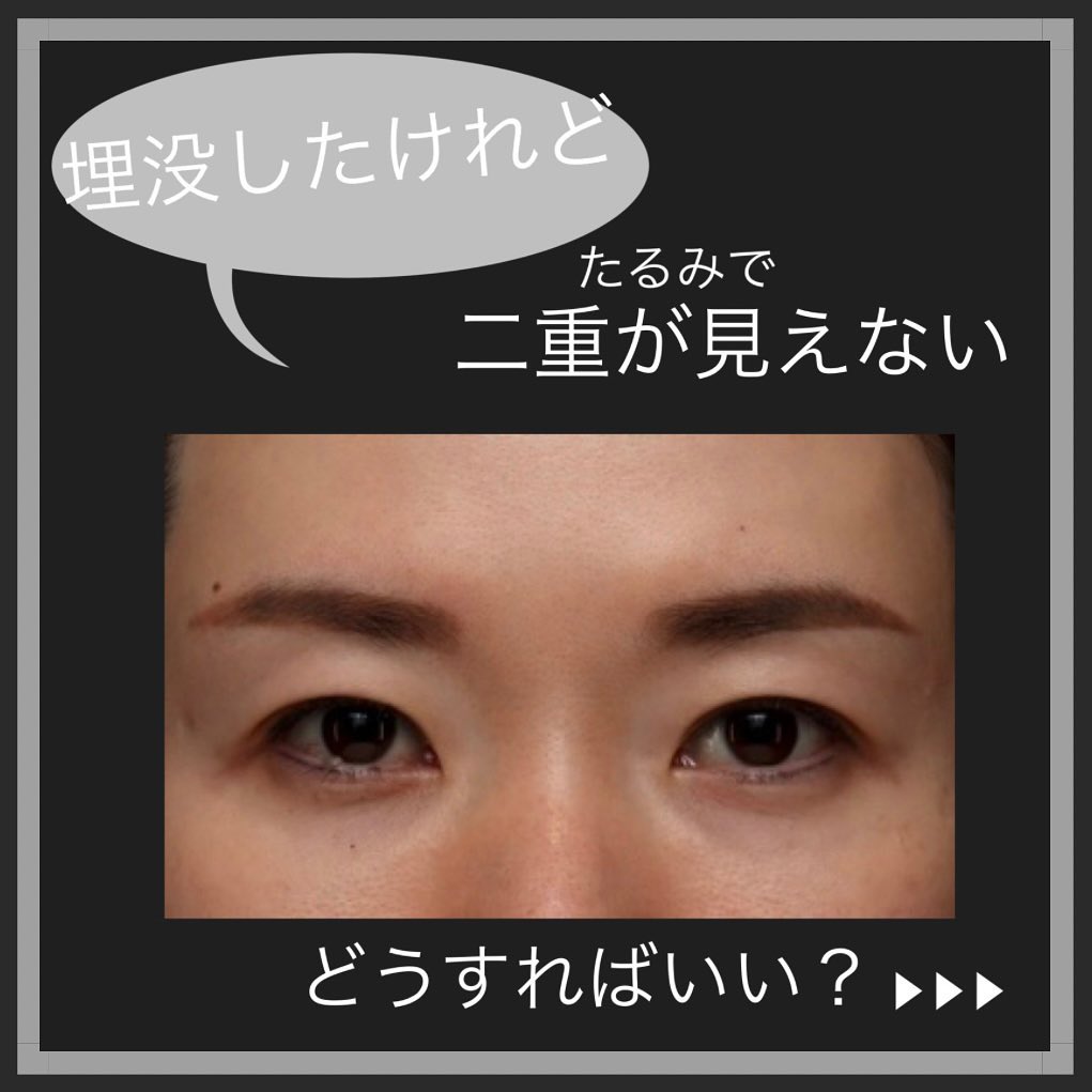 眉下切開＋二重埋没でたるみで隠れていた二重ラインをすっきり出した症例 画像2