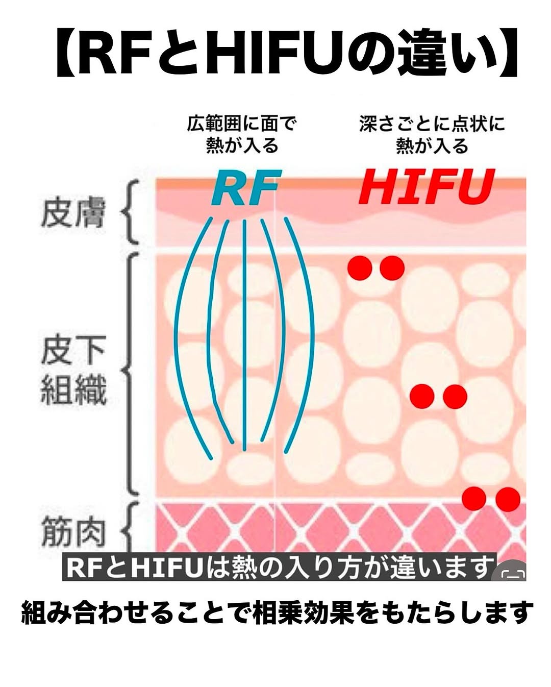 ウルトラセルZi（HIFU）＋ザーフ（RF）の組み合わせでたるみを全層引き締めた症例 画像2