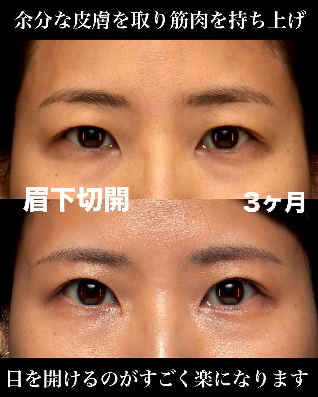 眉下切開でまぶたのたるみを自然に改善し少し昔の自分に戻った症例 画像2