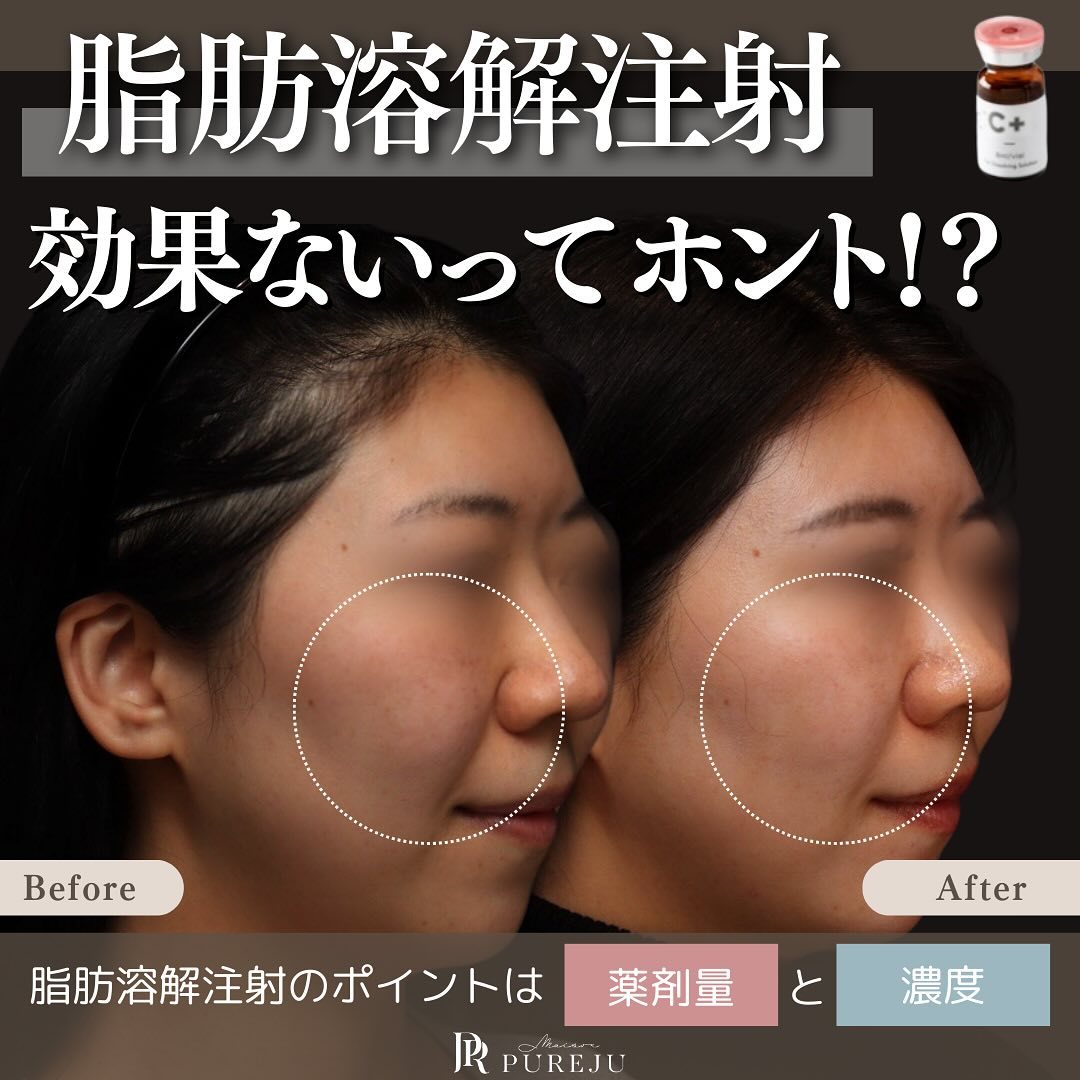 脂肪溶解注射は効果ない？｜チンセラプラスのデオキシコール酸濃度と注入量が結果を左右する理由