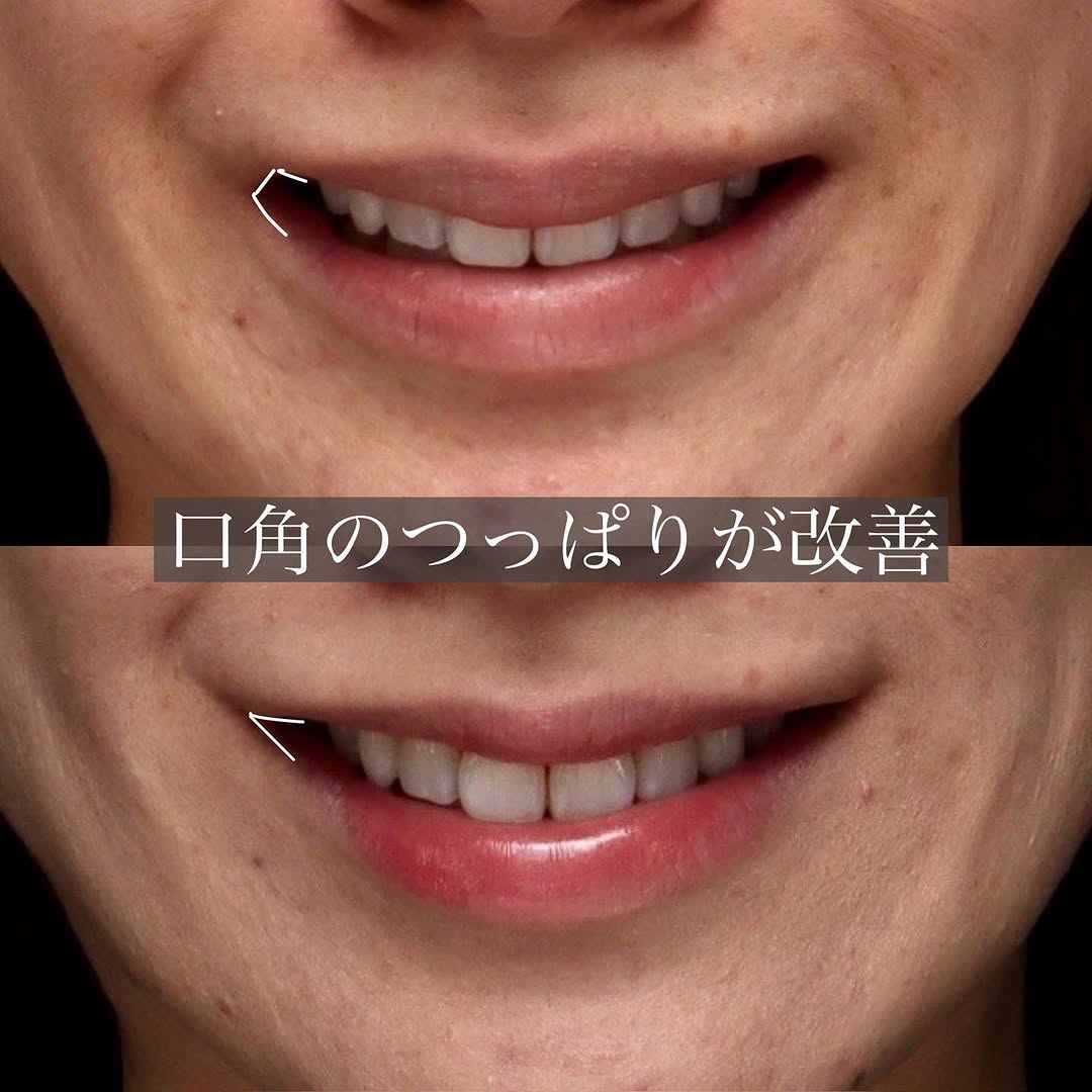 口角形成で真顔でも笑顔でも印象が上がった症例 画像3