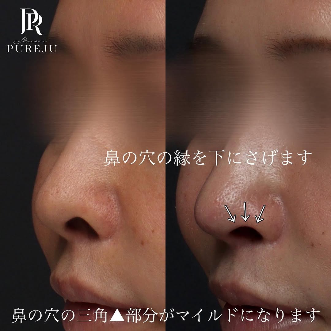 鼻孔縁下降＋鼻尖形成＋耳介軟骨移植で鼻の穴の目立ちを改善した症例 画像2
