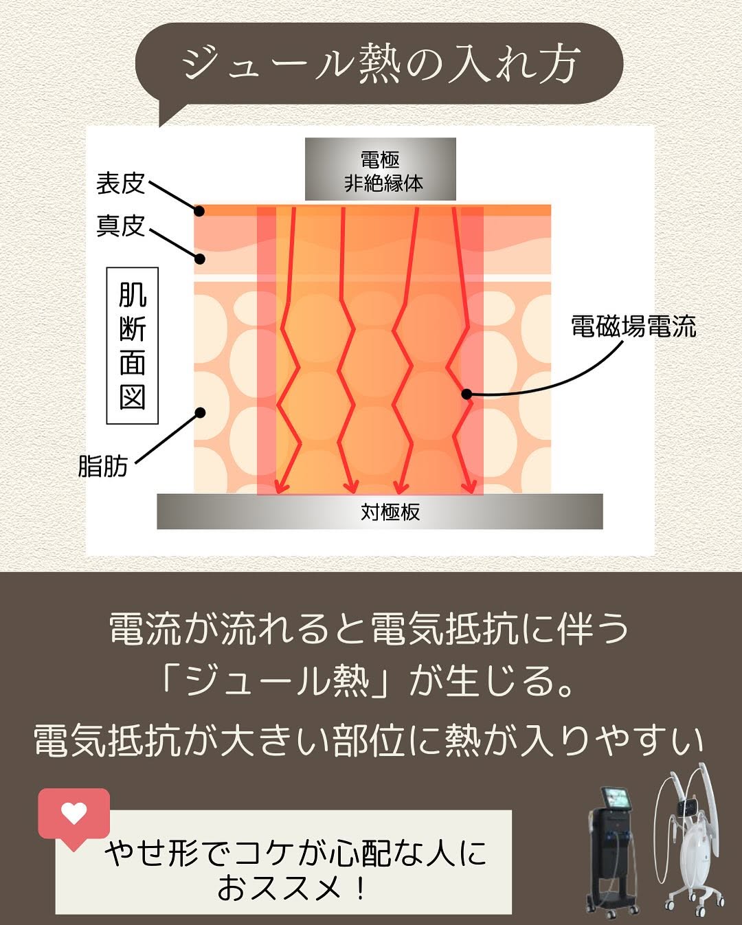 RF（ラジオ波）の加熱原理2種類｜ジュール熱と誘電加熱の違いと自分に合う機器の選び方 画像3