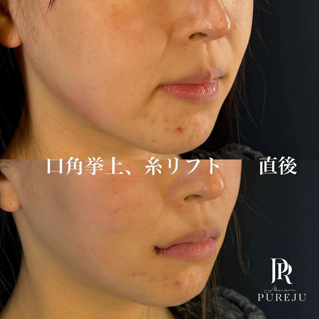 口角挙上＋糸リフトの直後ダウンタイム経過を示した症例 画像2
