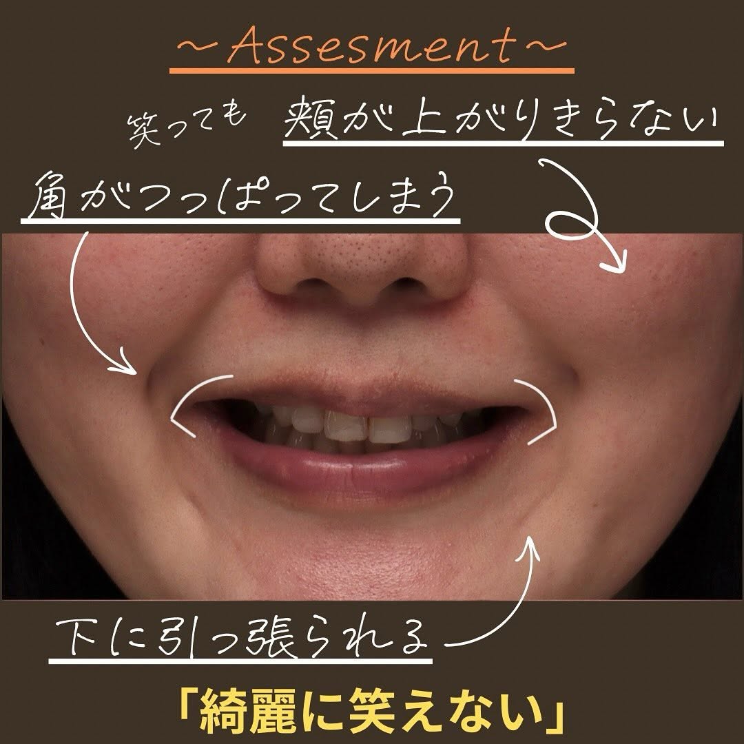 口角挙上で笑いにくさを改善しより魅力的な笑顔になった症例 画像2