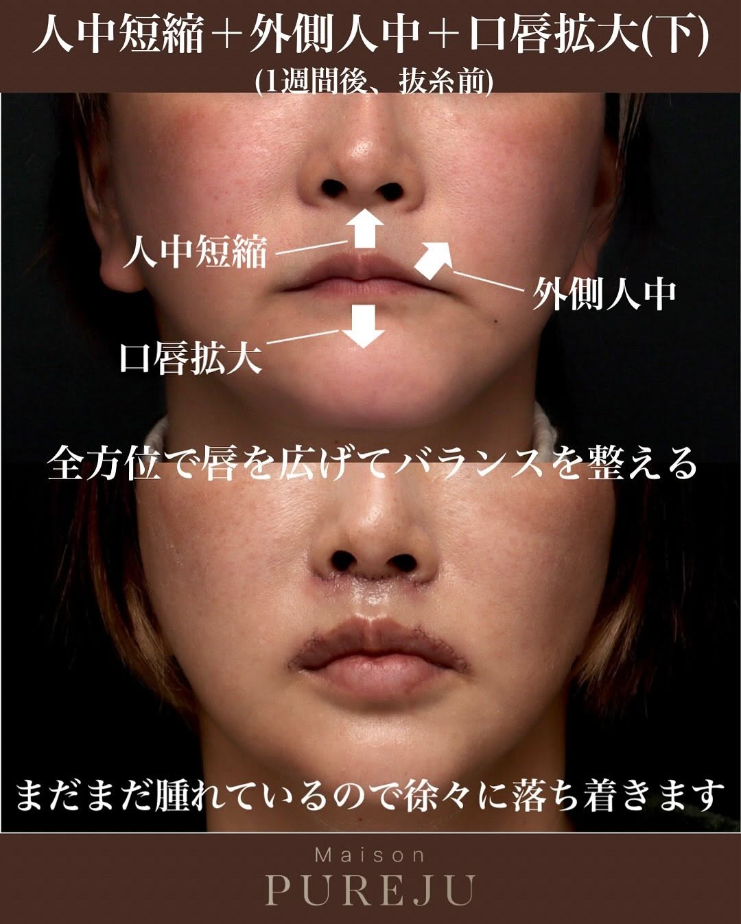 人中短縮＋外側人中＋口唇拡大で唇を全方位から拡大した術後1週間の症例 画像2