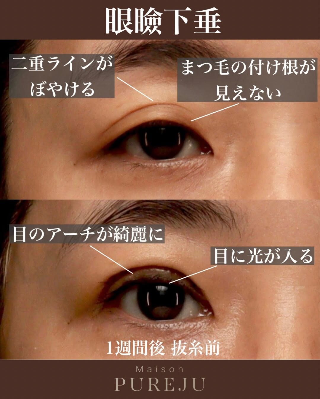 眼瞼下垂手術術後1週間（抜糸前）のダウンタイム経過を記録した症例 画像2