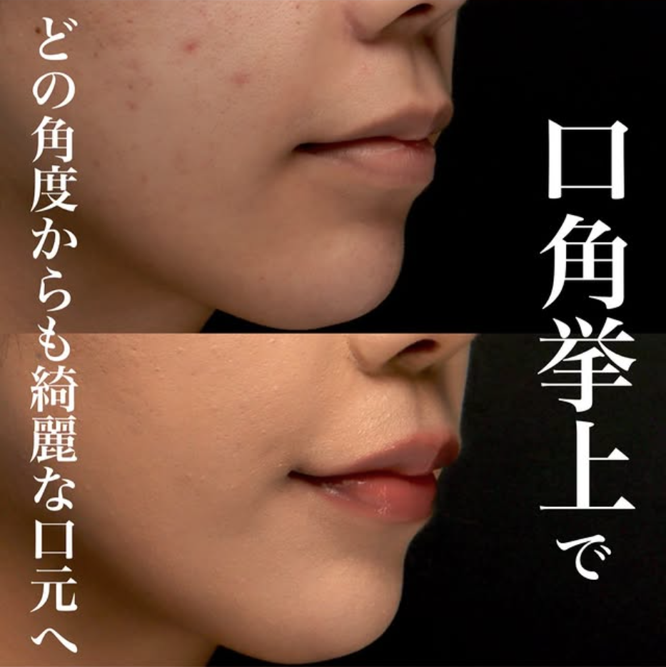 口角挙上でどの角度から見ても口角の上がった口元にした症例（術後1ヶ月）