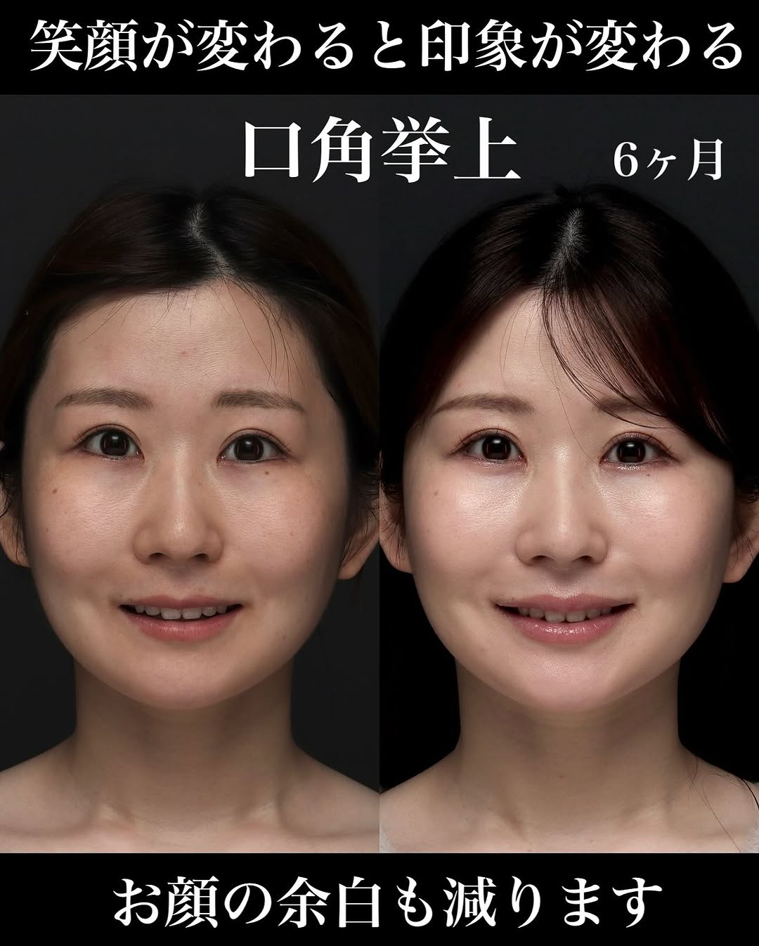 口角挙上＋ヒアルロン酸で術後6ヶ月笑顔が格段に良くなった症例