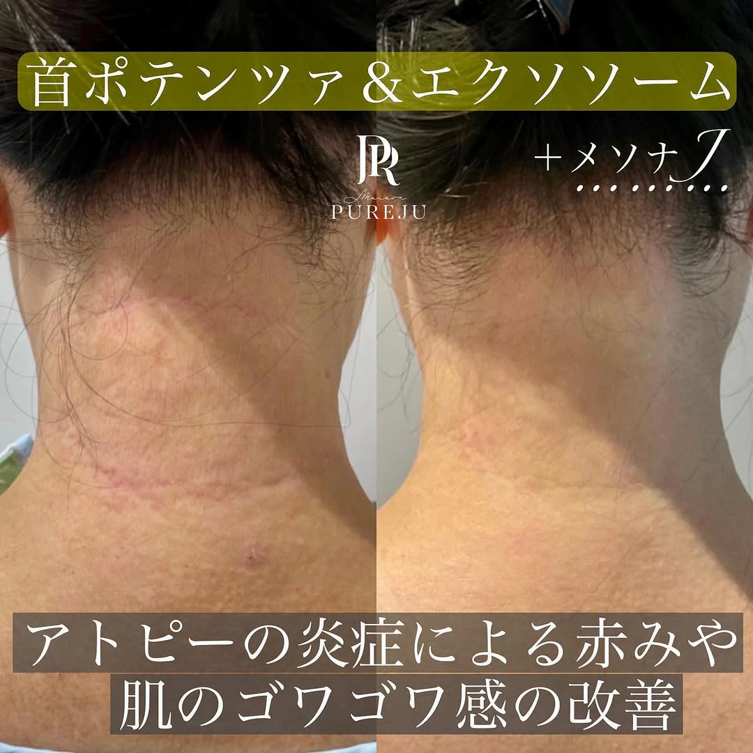 首のアトピー性皮膚炎にポテンツァ×エクソソーム×メソナJで肌の炎症と赤みを改善した症例