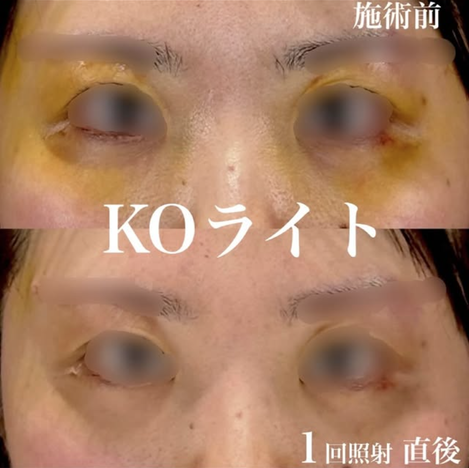 KOライトで手術後の内出血と腫れの回復を早めた症例（1回照射直後）