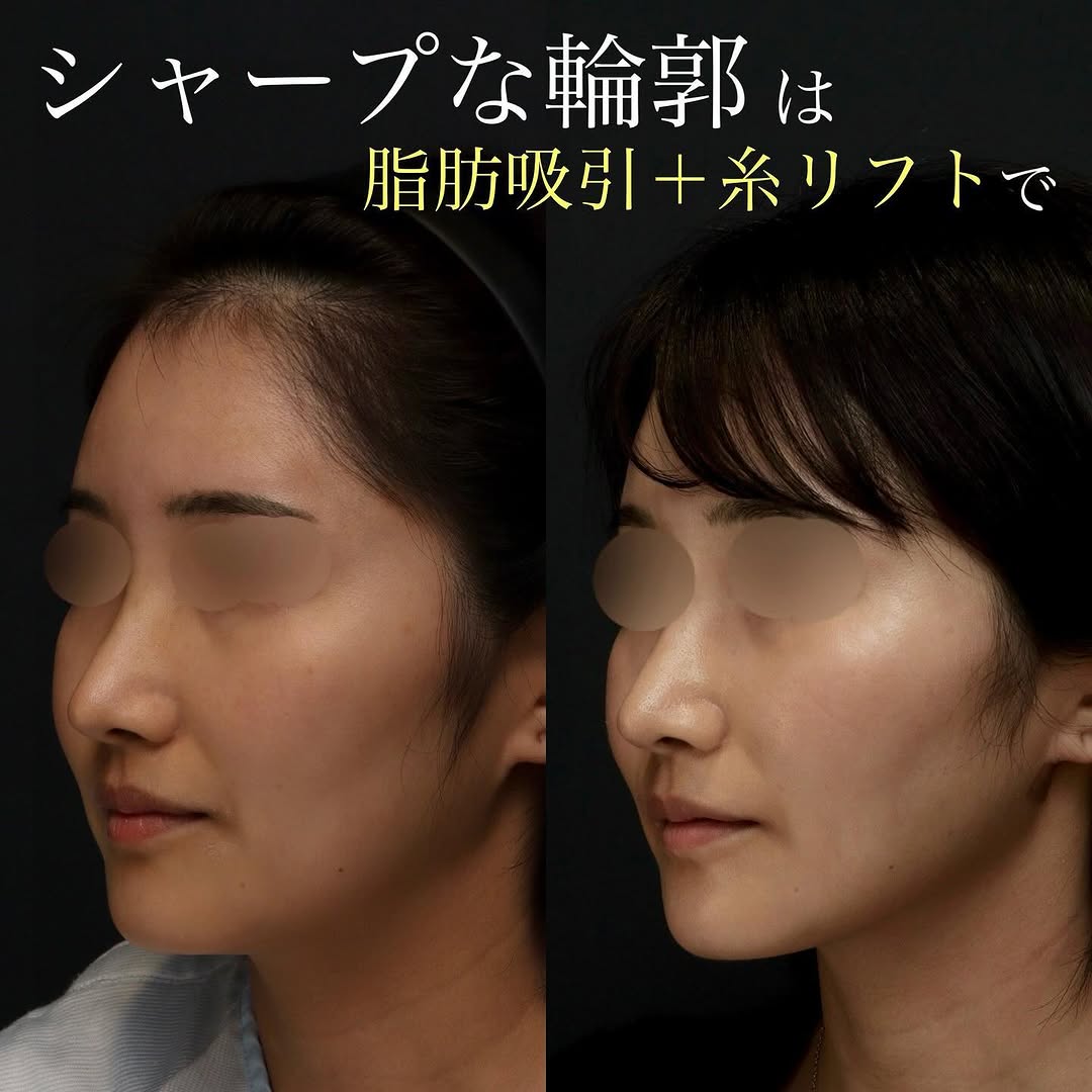 糸リフト＋脂肪吸引の組み合わせでしっかり小顔に整えた症例