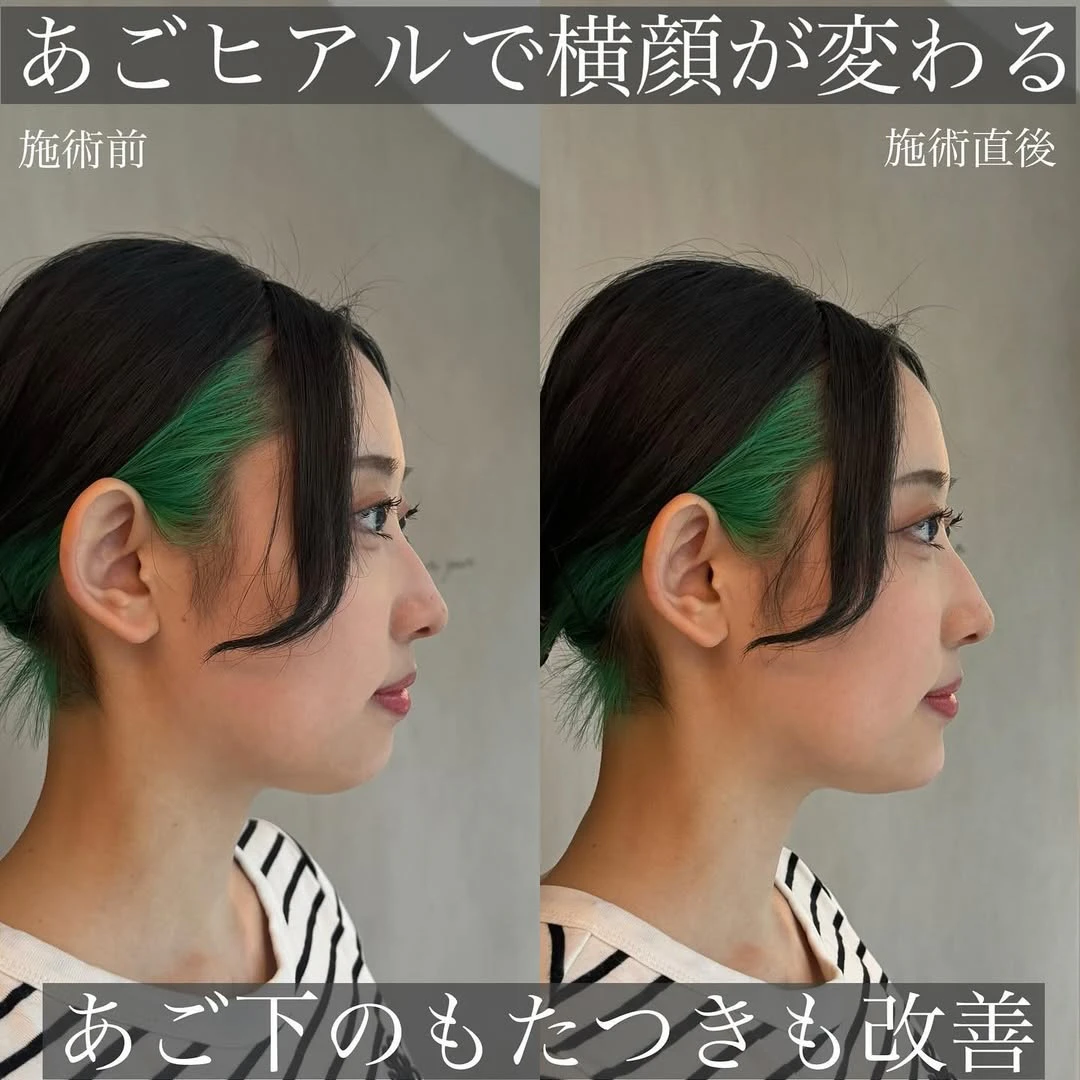 あごのヒアルロン酸で輪郭のバランスを自然に整えた症例