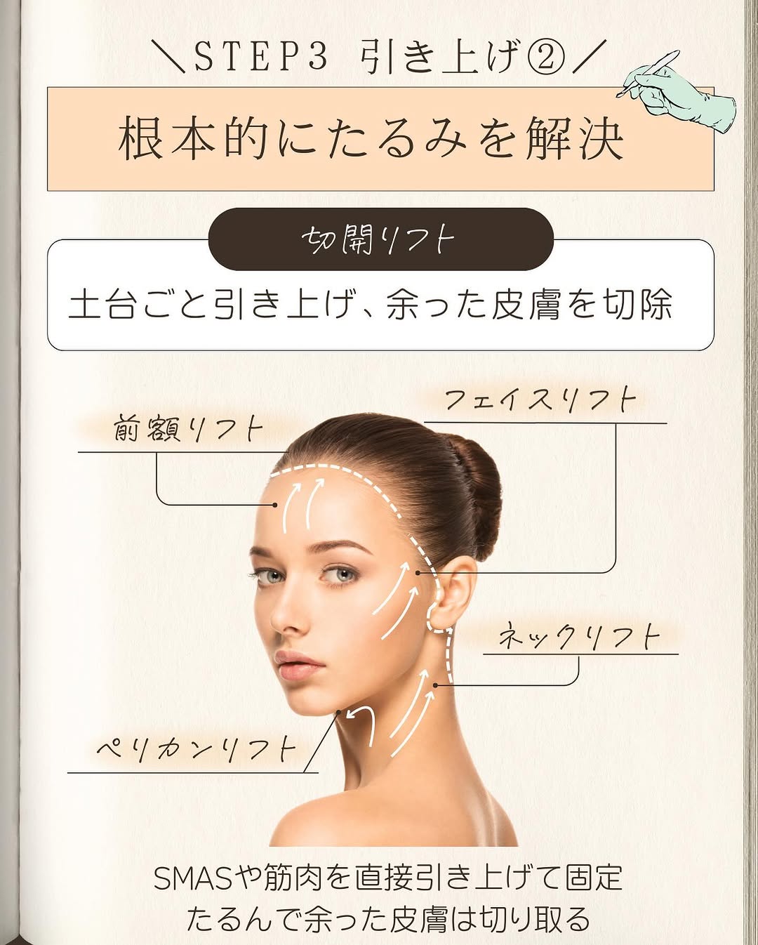たるみ治療まとめ｜予防・引き締め・引き上げの3STEPと施術の選び方を医師が解説 画像7