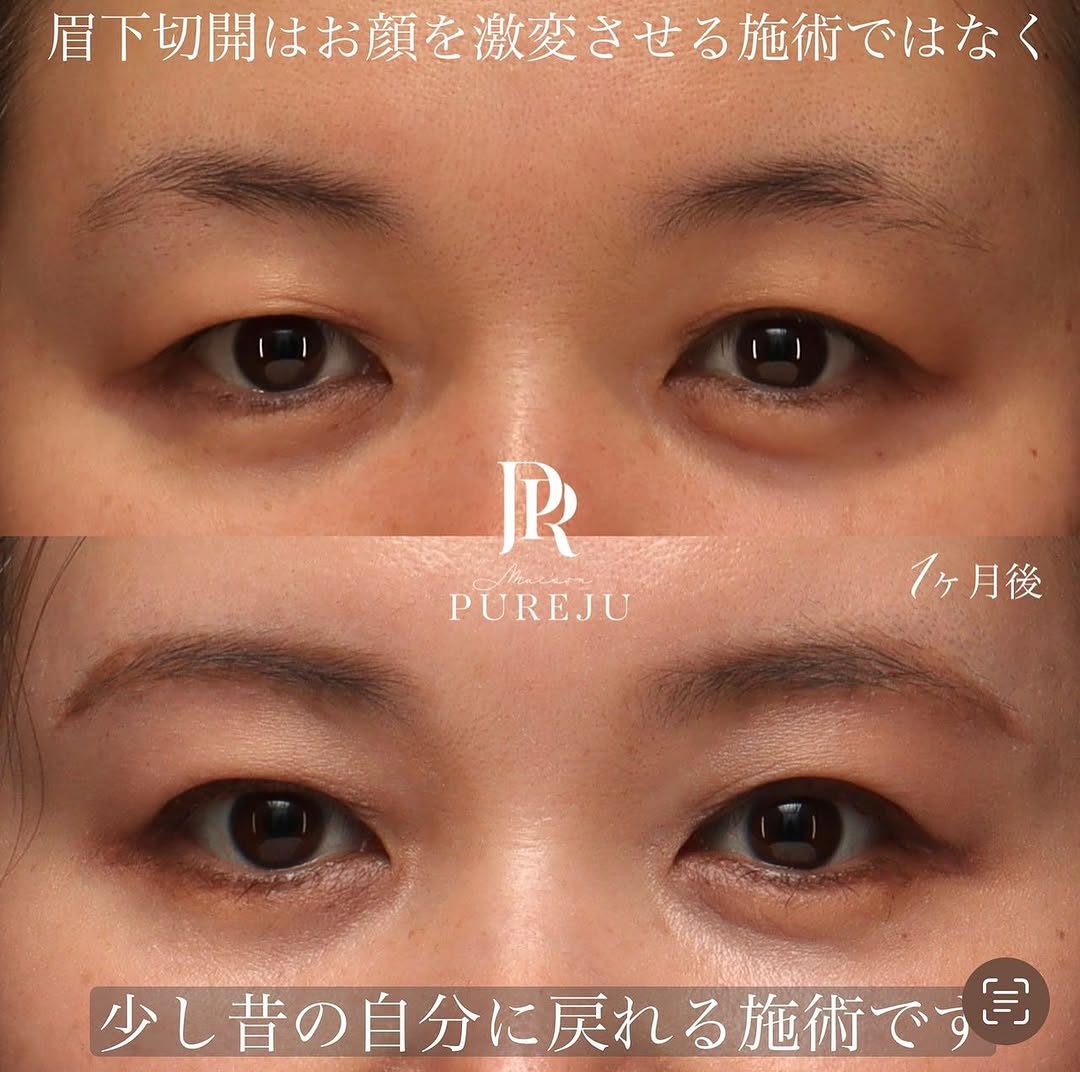 眉下切開でまぶたのたるみを改善し少し昔の自分に戻った症例（術後1ヶ月）