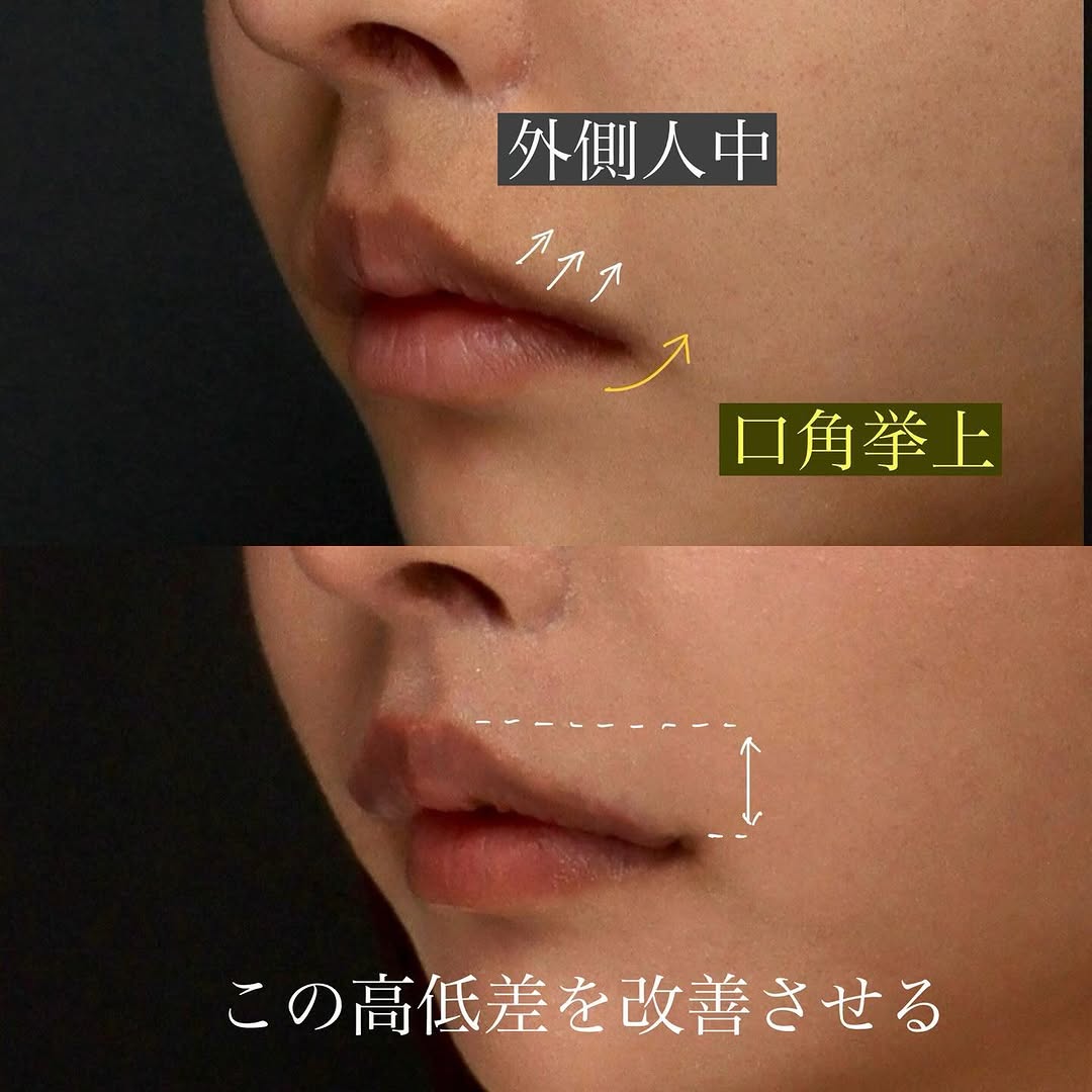 他院人中短縮後の口角挙上＋外側人中で唇全体のバランスを整えた症例 画像2
