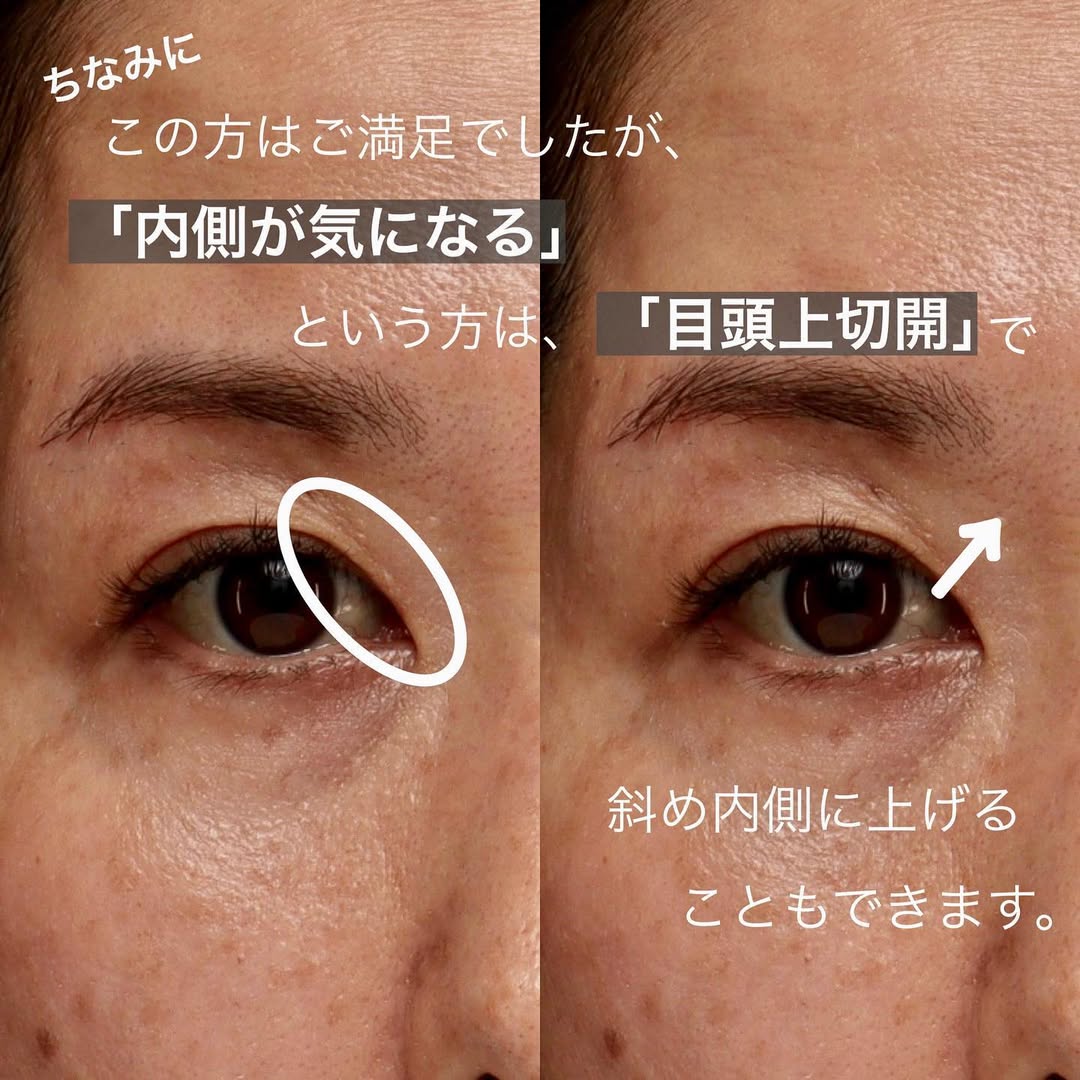 眉下切開で埋もれた二重とまつ毛を復活させ昔の目元に戻した症例（術後3ヶ月） 画像4