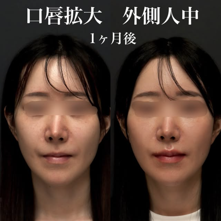 他院人中短縮後に口唇拡大＋外側人中短縮で人中を切らずに短く立体的に見せた症例（術後1週間〜1ヶ月の経過）