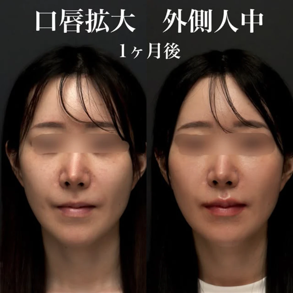他院人中短縮後に口唇拡大+外側人中短縮で人中を切らずに短く立体的に見せた症例(術後1週間〜1ヶ月の経過)