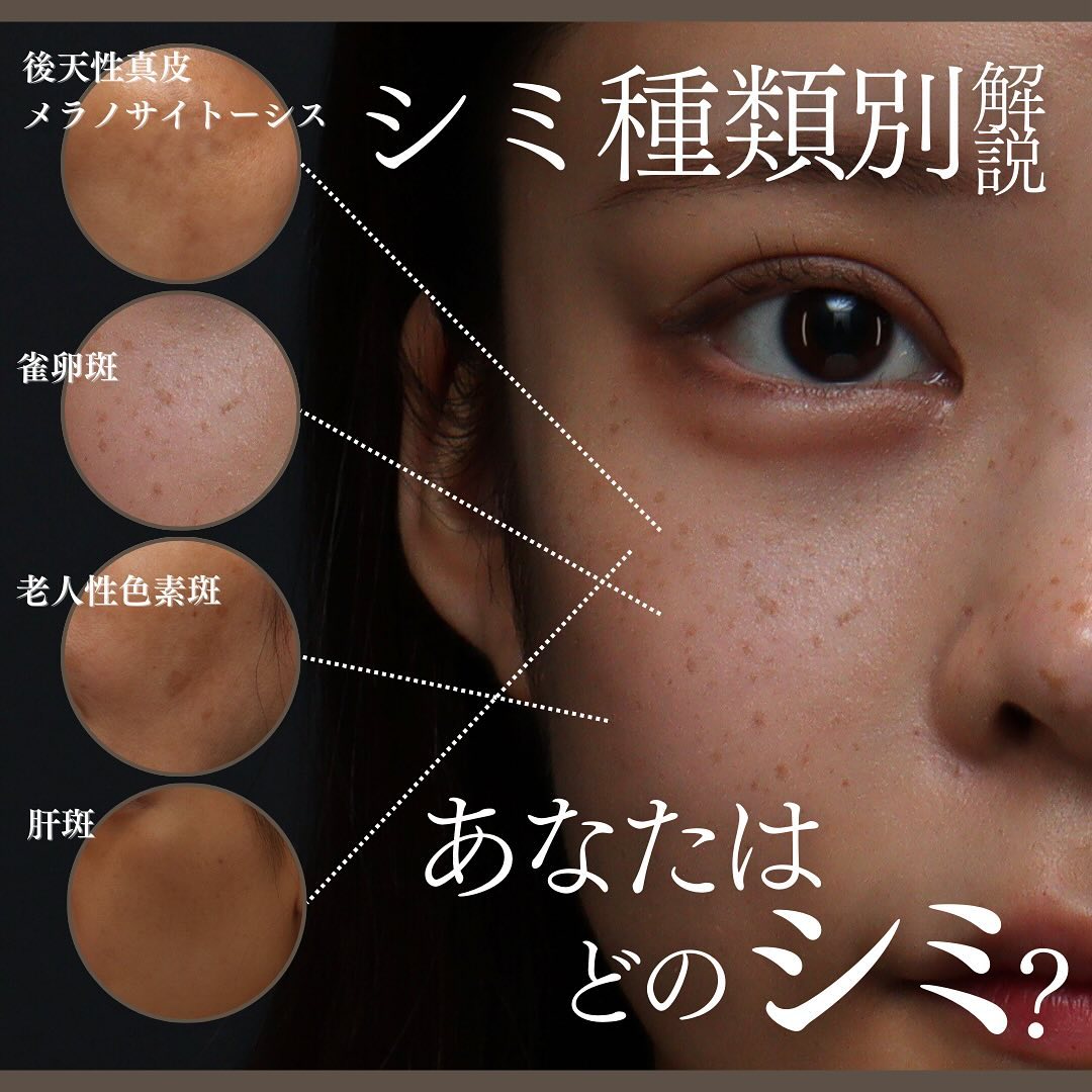 シミの種類4つを徹底解説｜ADM・そばかす・老人性色素斑・肝斑の特徴とおすすめ治療