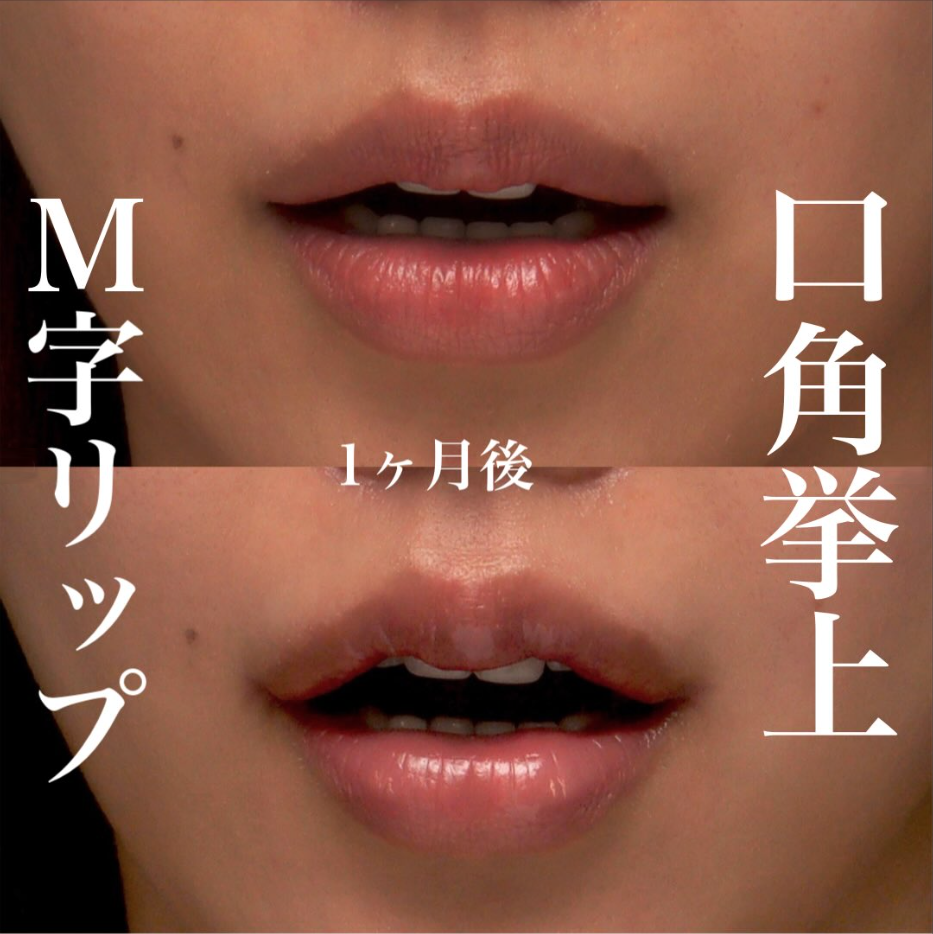 M字リップ＋口角挙上で唇の比率を整え立体感のある口元にした症例（術後1ヶ月） 画像2