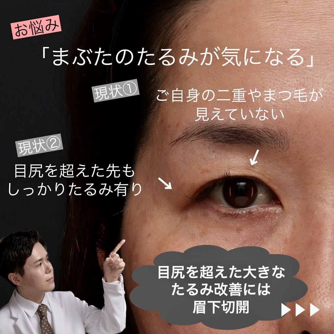 眉下切開で埋もれた二重とまつ毛を復活させ昔の目元に戻した症例（術後3ヶ月） 画像2