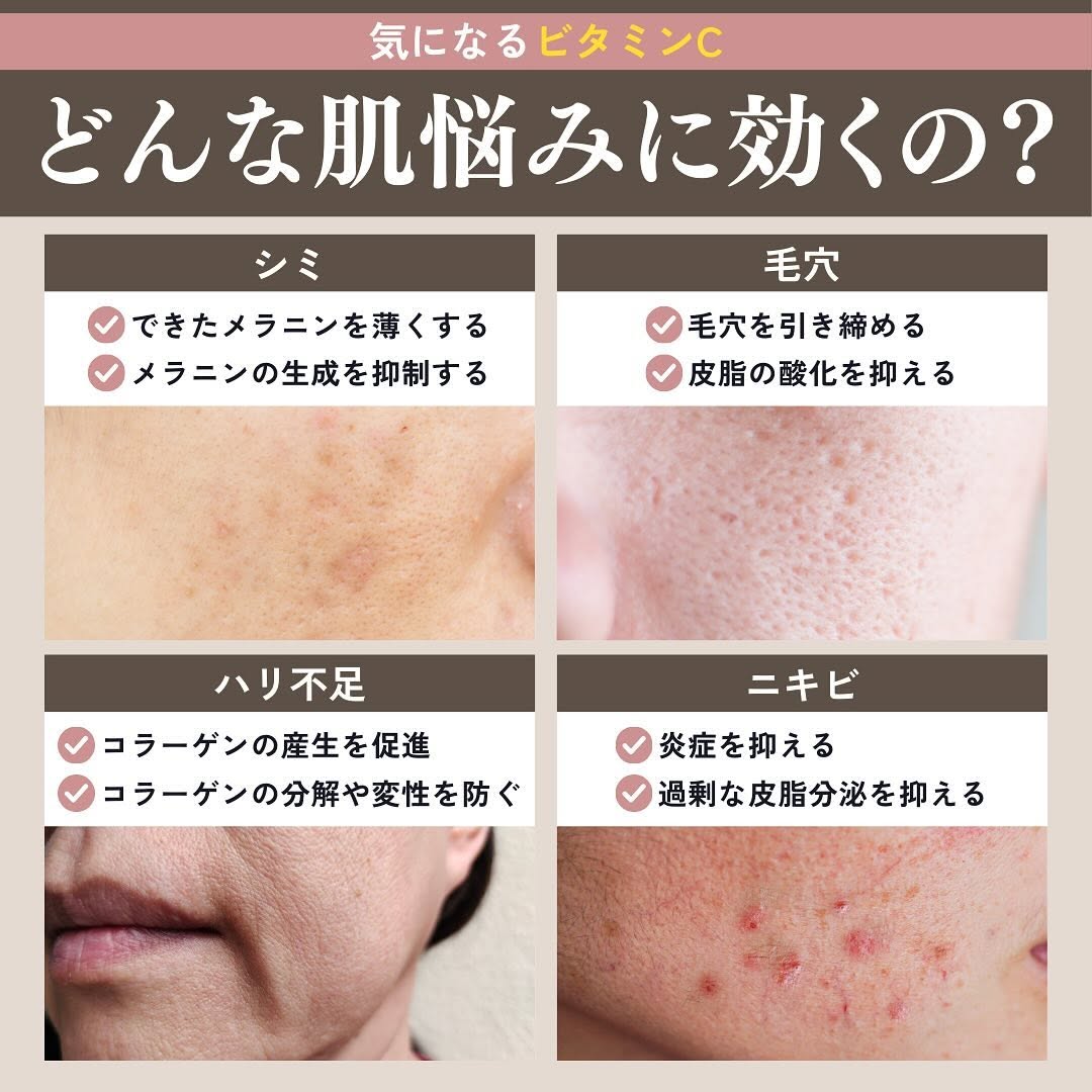 ビタミンCが肌に効く理由｜シミ・毛穴・ニキビ・ハリ不足への作用とQ&A 画像2