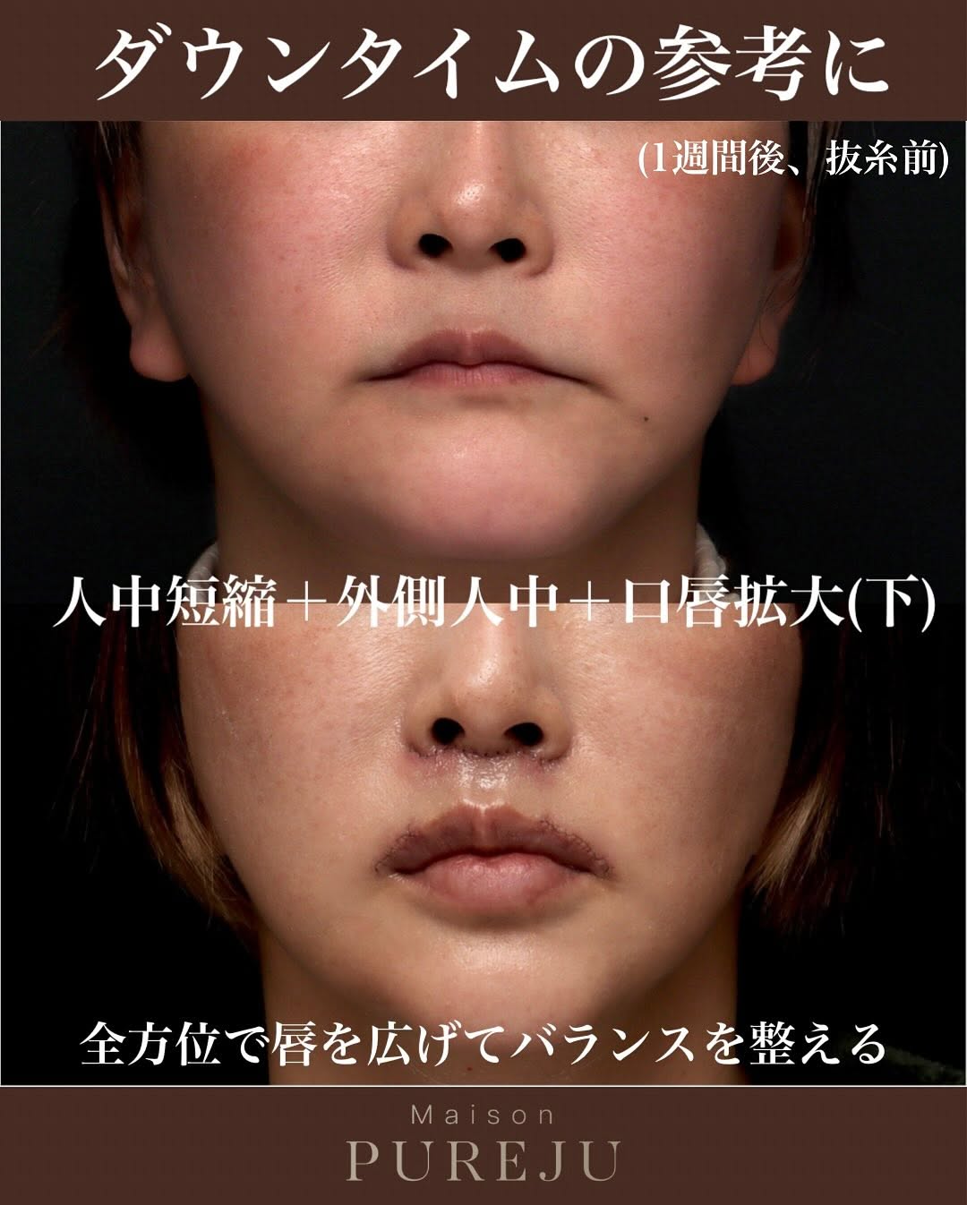 人中短縮＋外側人中＋口唇拡大で唇を全方位から拡大した術後1週間の症例