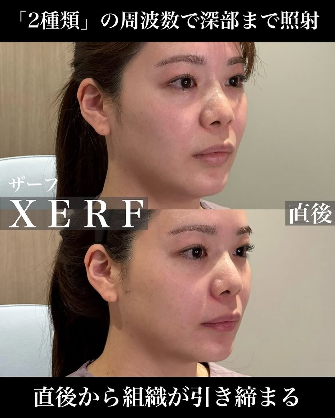 ザーフ（XERF）直後のフェイスラインのピタッとした引き締め効果を実感した症例