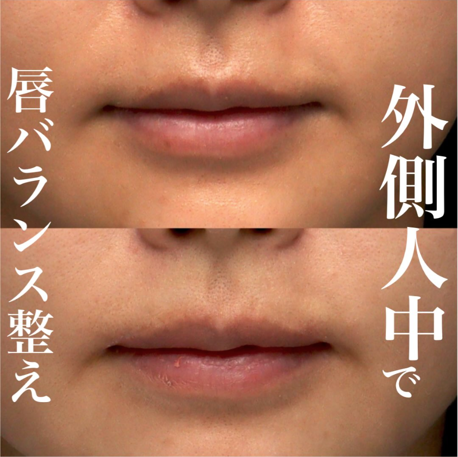 外側人中短縮で唇の端まで見えるバランスの良い口元にした症例（術後6ヶ月・メイクなし）