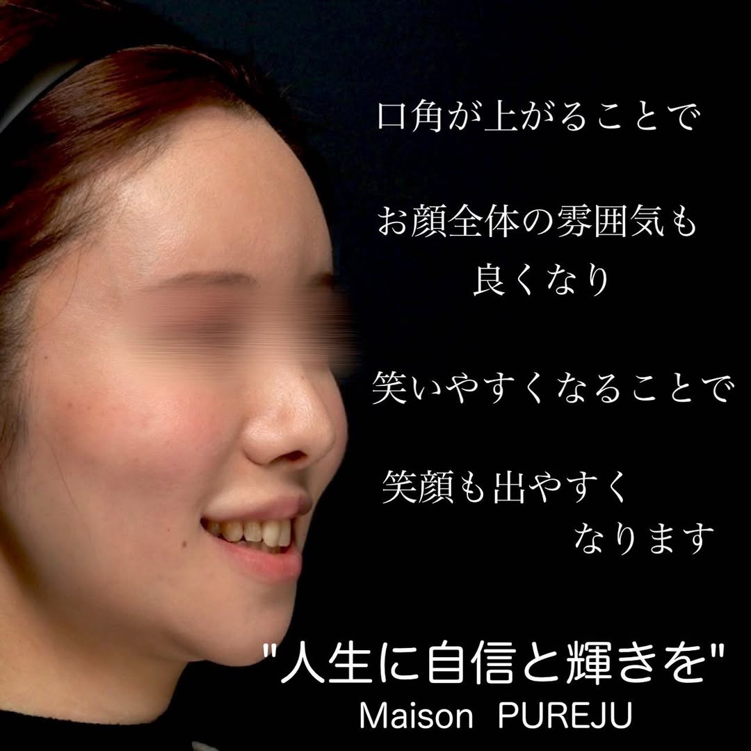 口角挙上で笑いやすさと口角の上がりを同時に改善した症例 画像6