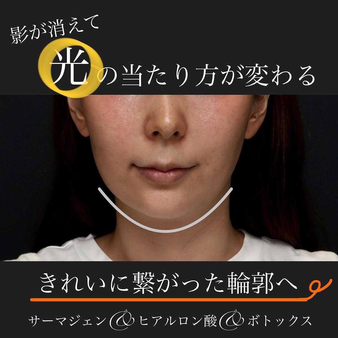 ボトックス×ヒアルロン酸×サーマジェンのコンビネーション治療で下顔面を整えた症例 画像3