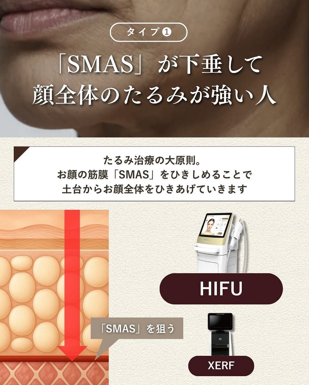 たるみ治療4層別アプローチ（機械編）｜SMAS・脂肪層・真皮深層・真皮浅層ごとに最適な機器を解説 画像2