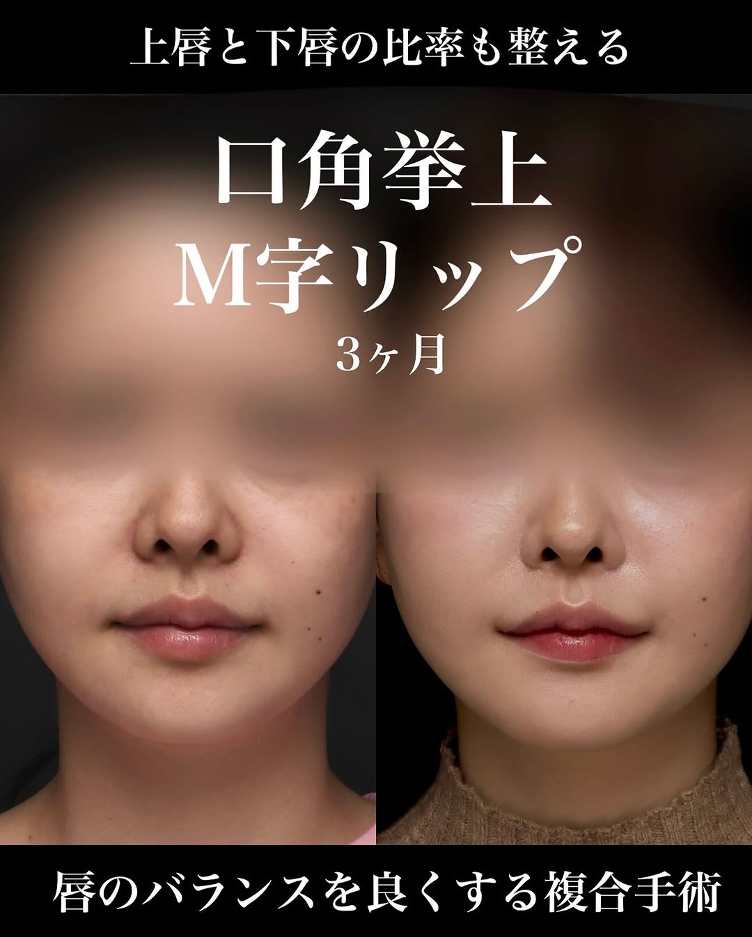 口角挙上＋M字リップで唇の黄金比に近づけ上品な印象に整えた症例