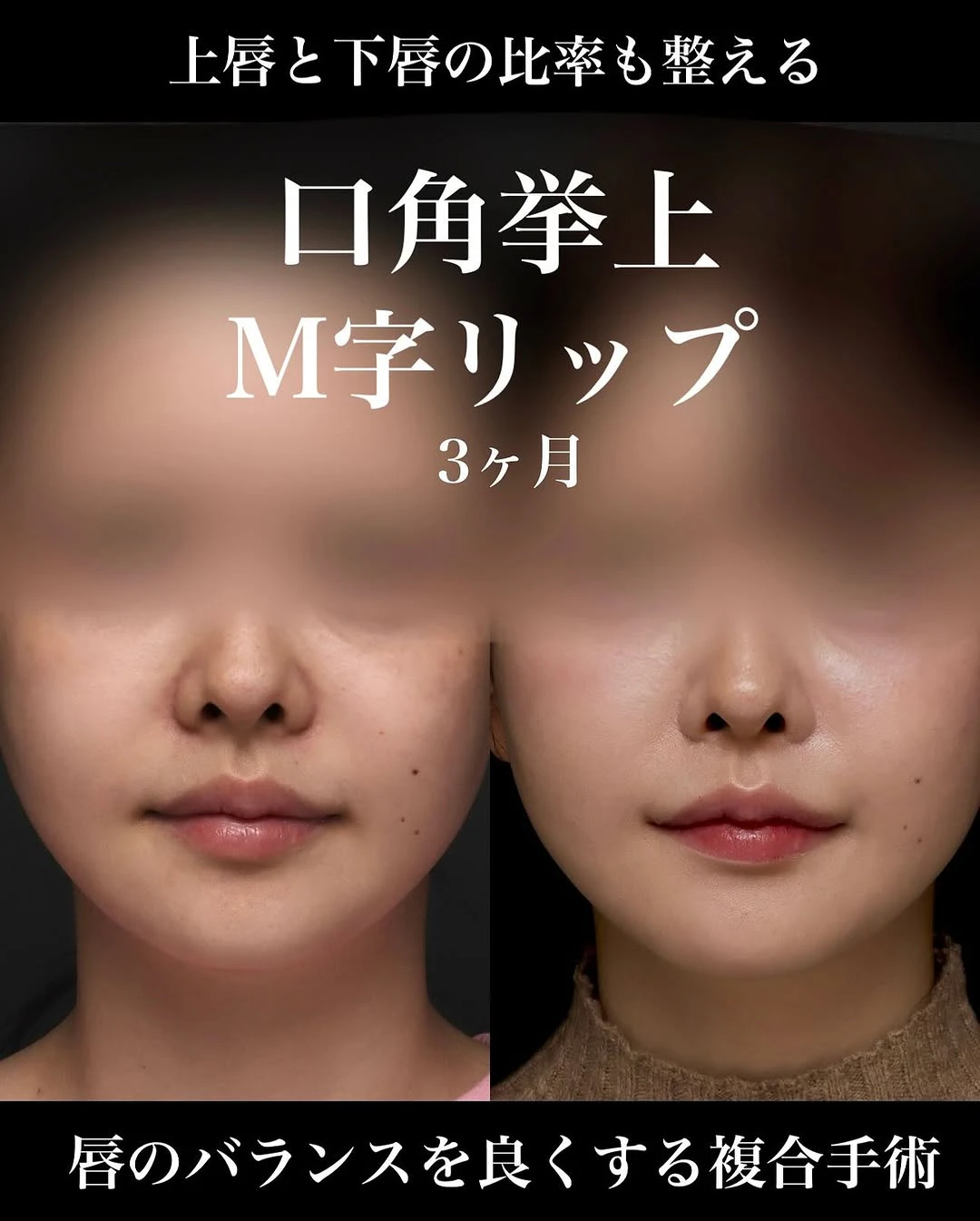 口角挙上+M字リップで唇の黄金比に近づけ上品な印象に整えた症例