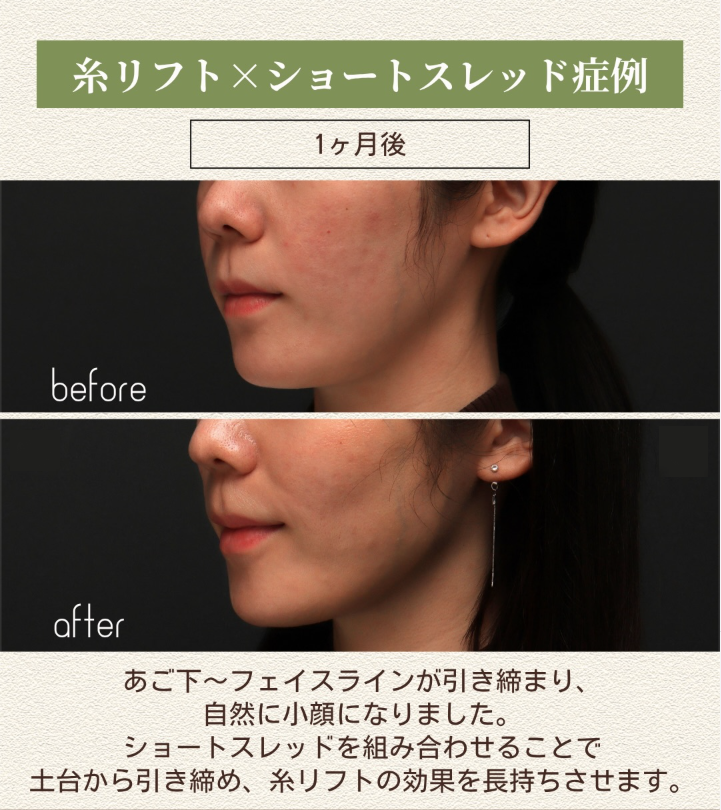 糸リフト＋ショートスレッドであご下からフェイスラインを自然に引き締めた症例（1ヶ月後） 画像2