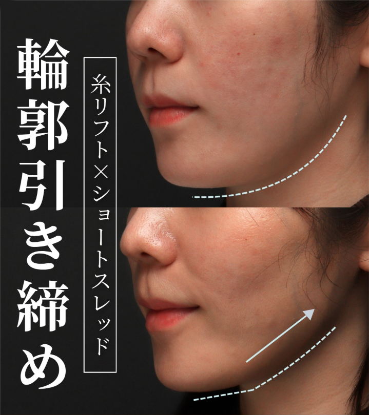糸リフト＋ショートスレッドであご下からフェイスラインを自然に引き締めた症例（1ヶ月後）