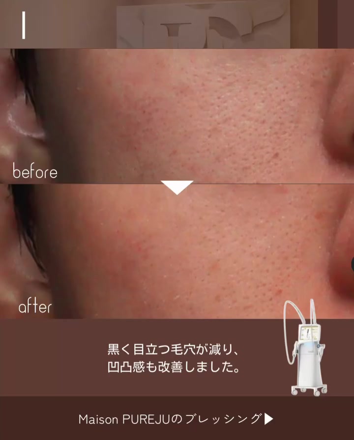 ブレッシングで毛穴レス肌を目指した広範囲ニードルRFと薬剤の複合施術症例 画像3